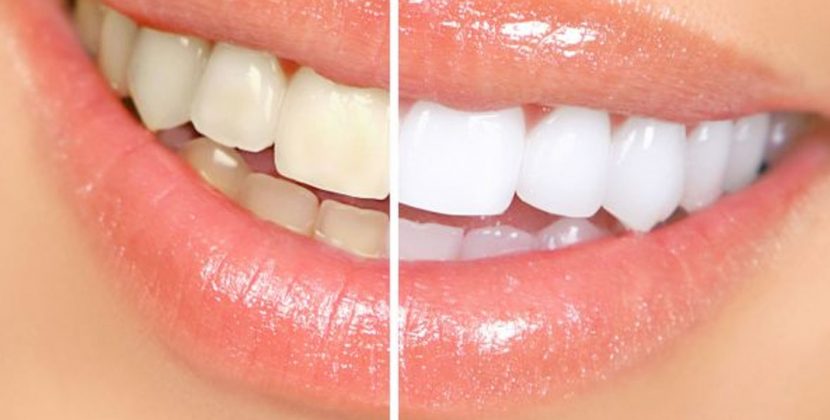 Como o clareamento dental vem crescendo?